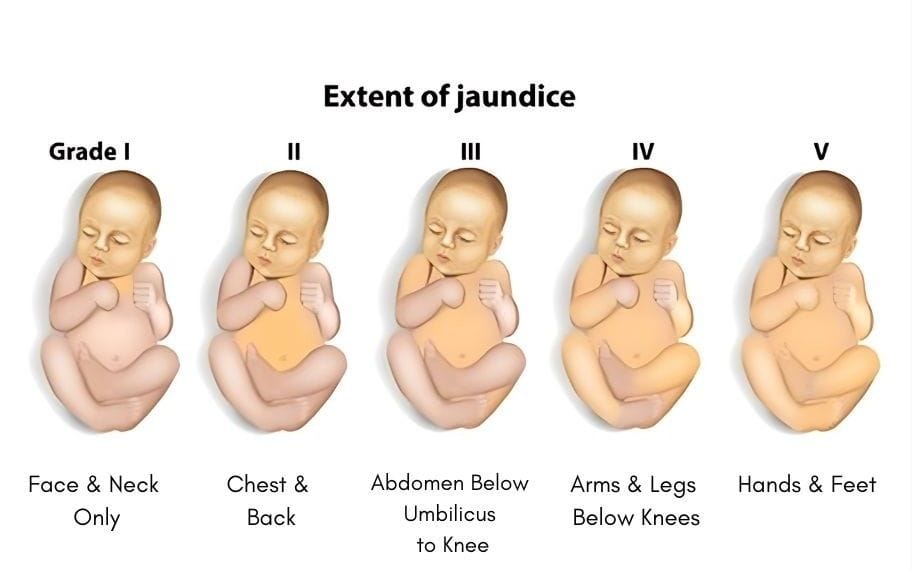 extent-of-jaundice.jpg